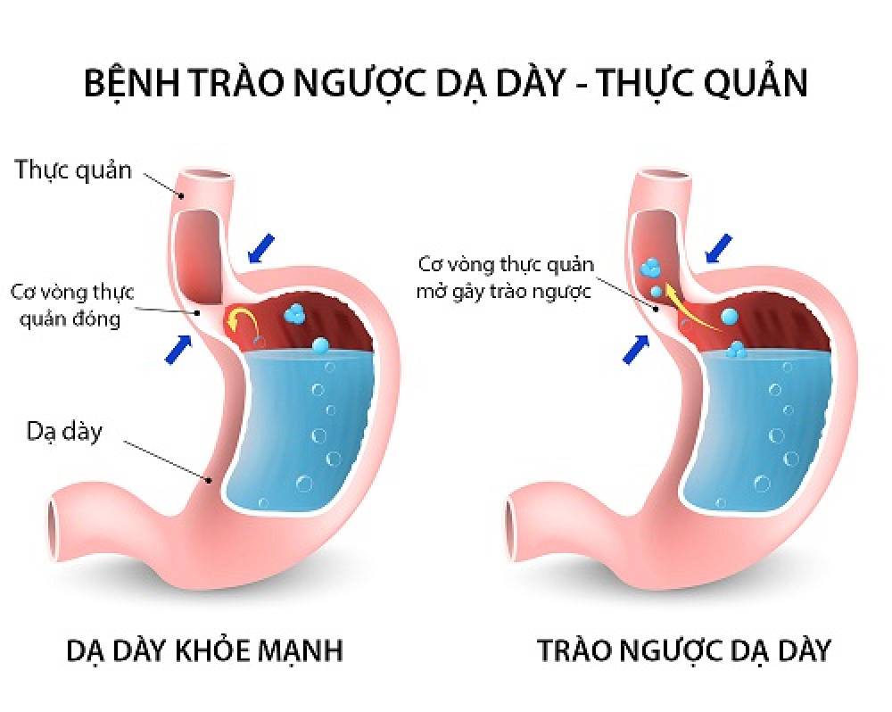 CÁCH NGĂN CHẶN TÌNH TRẠNG TRÀO NGƯỢC AXIT DẠ DÀY