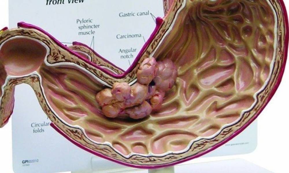 CẨN THẬN KHI BỊ POLYP DẠ DÀY