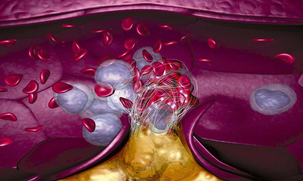 NGUYÊN NHÂN GÂY MỠ MÁU CAO